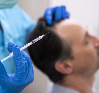 Mesotherapy for hair is a treatment method where you inject vitamins, minerals, and amino acid cocktails that are necessary for hair growth into the scalp.