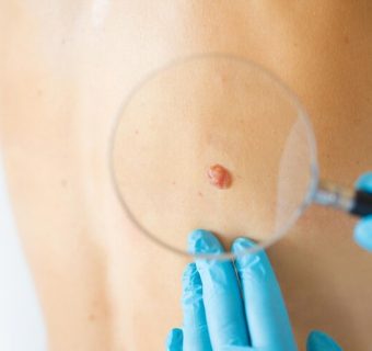 A skin biopsy is a procedure that removes a small sample of skin for testing. The procedure can help diagnose a skin lesion (an abnormal area of skin).